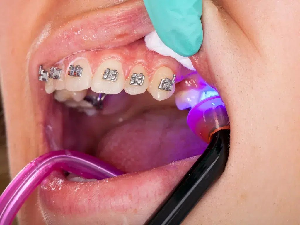 What is Orthodontics in Dubai? Best Dubai