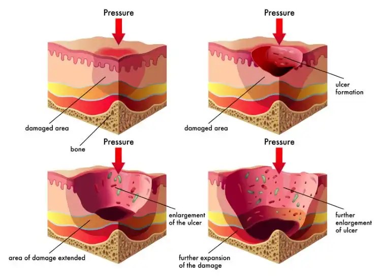 How To Prevent And Manage Pressure Sores Effectively Best Mobility Aids