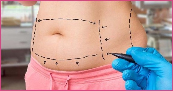 Cost Of Tummy Tuck And Location Best Plastic Surgery Before and After