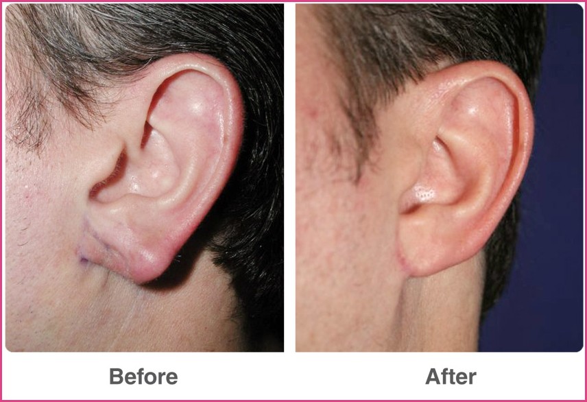 Ear Plastic Surgery Best Plastic Surgery Before and After