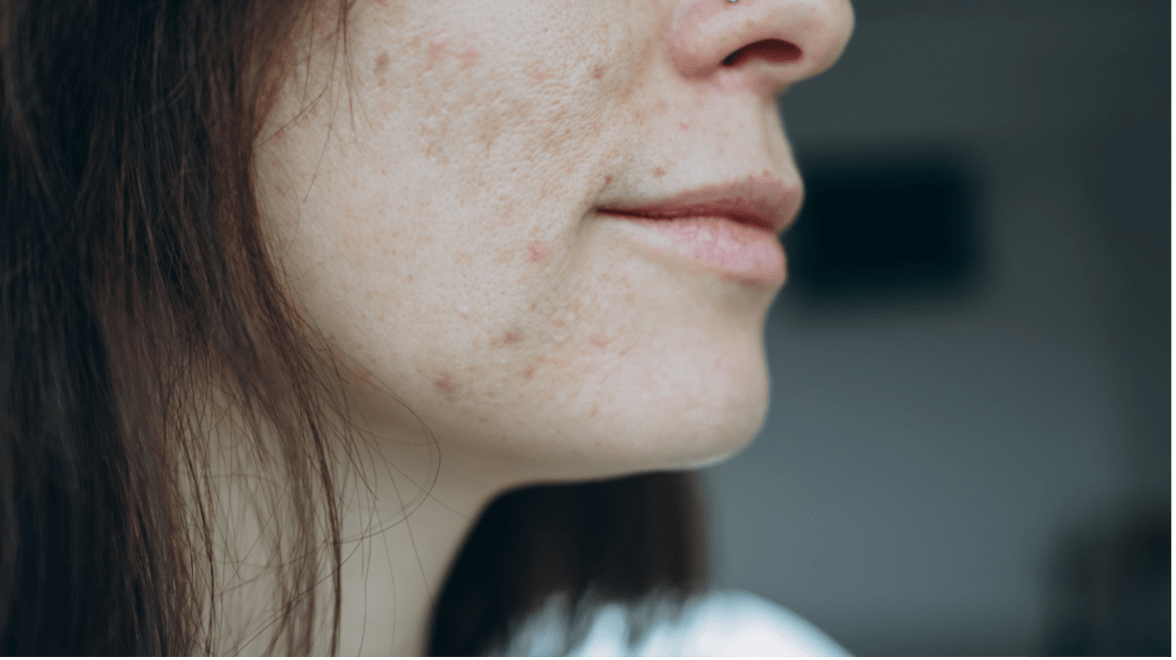 3 Underlying Causes of Adult Acne That You Should Know