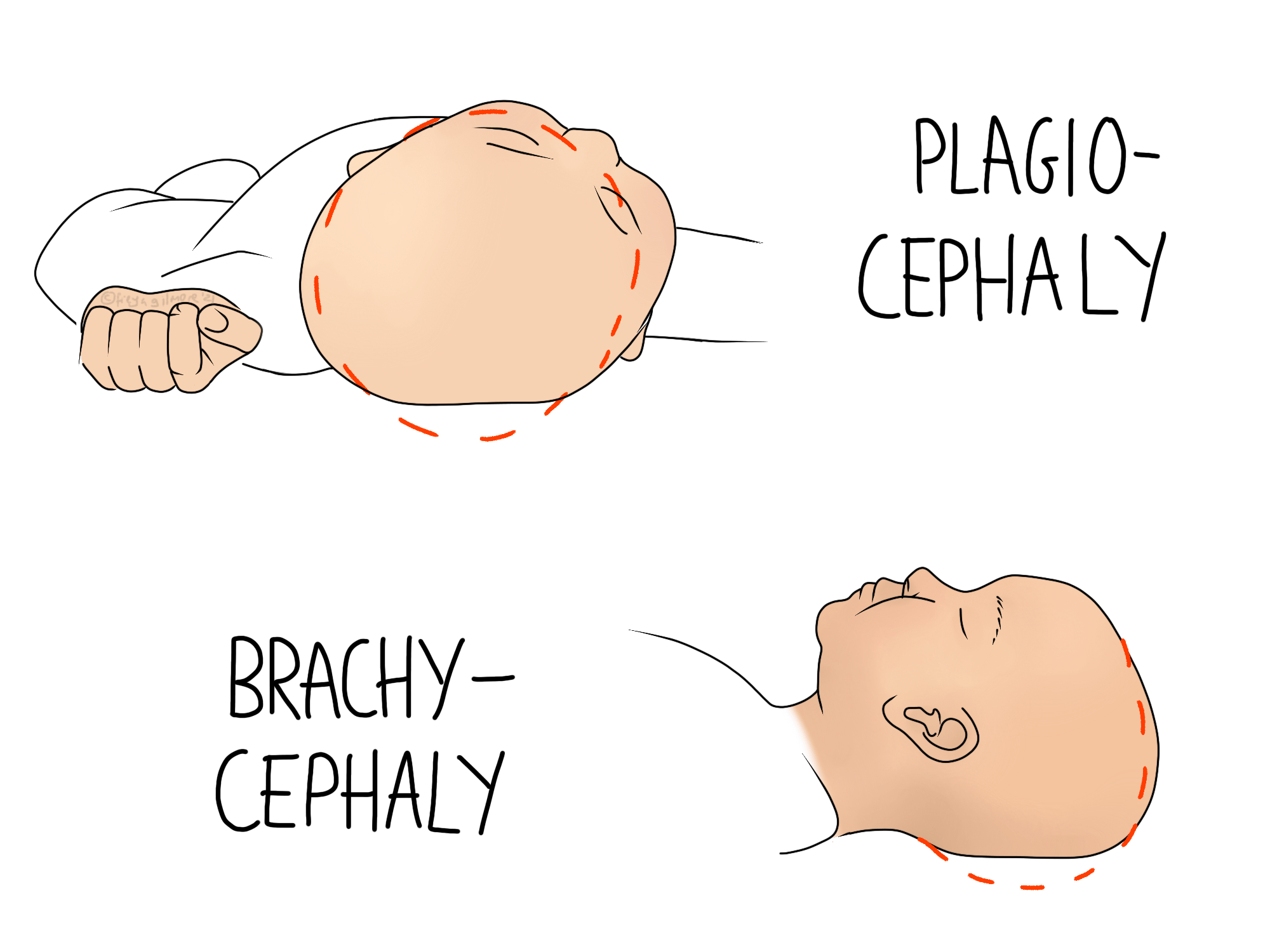 Plagiocephaly