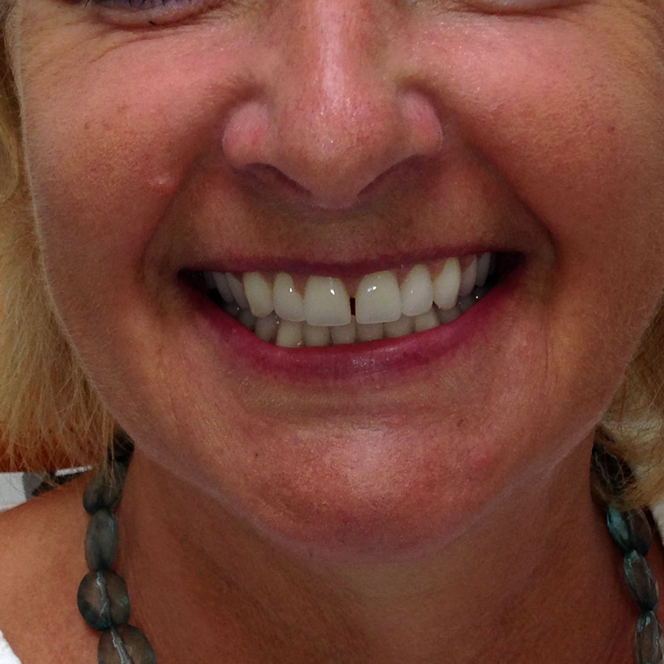 Cosmetic Dentures Natural Looking Dentures