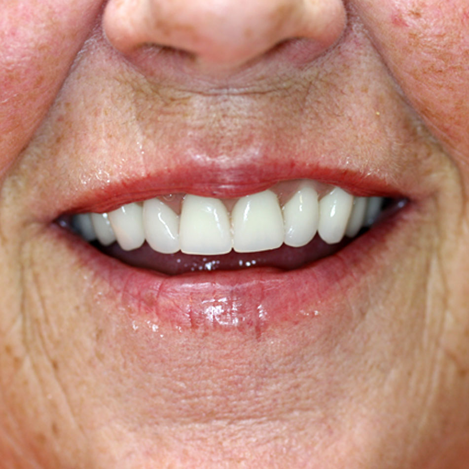 Cosmetic Dentures Natural Looking Dentures from the Cosmetic Denture Clinic