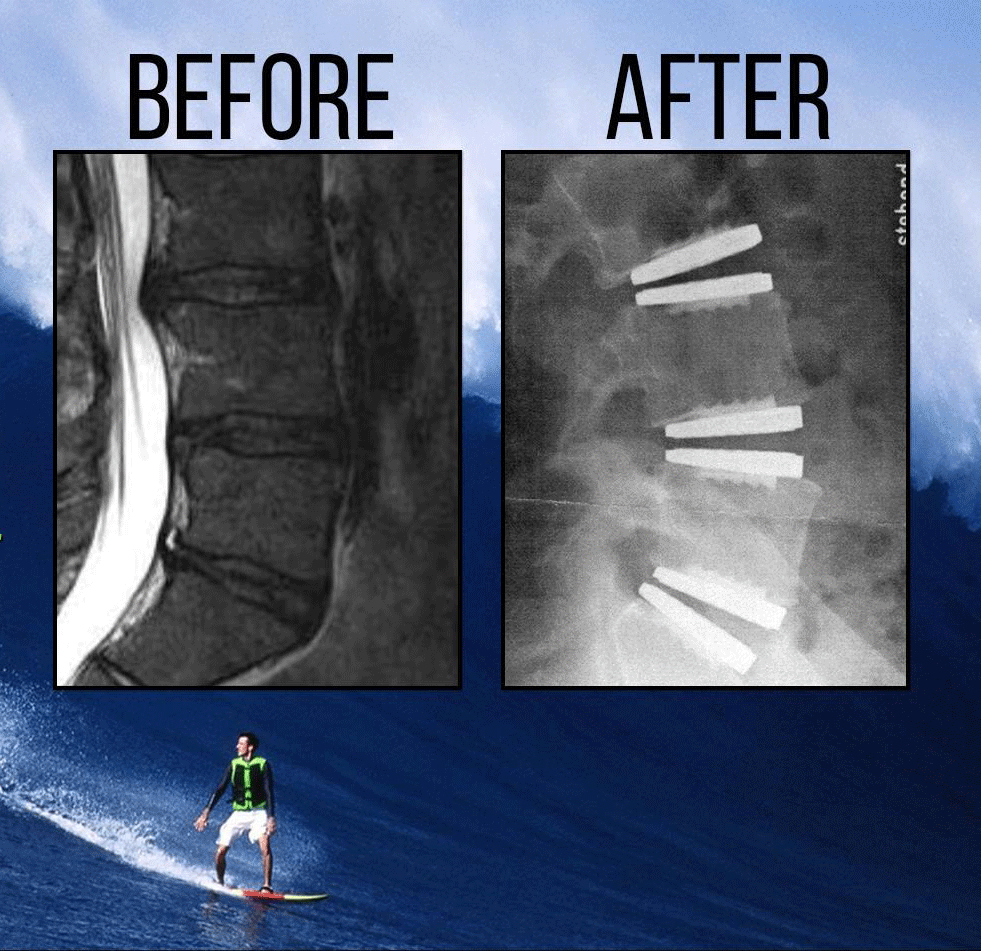 discreplacementtimhendricksbeforeafterxray Better Disc Replacement
