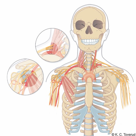 Thoracic Outlet Syndrome (TOS) BevApp