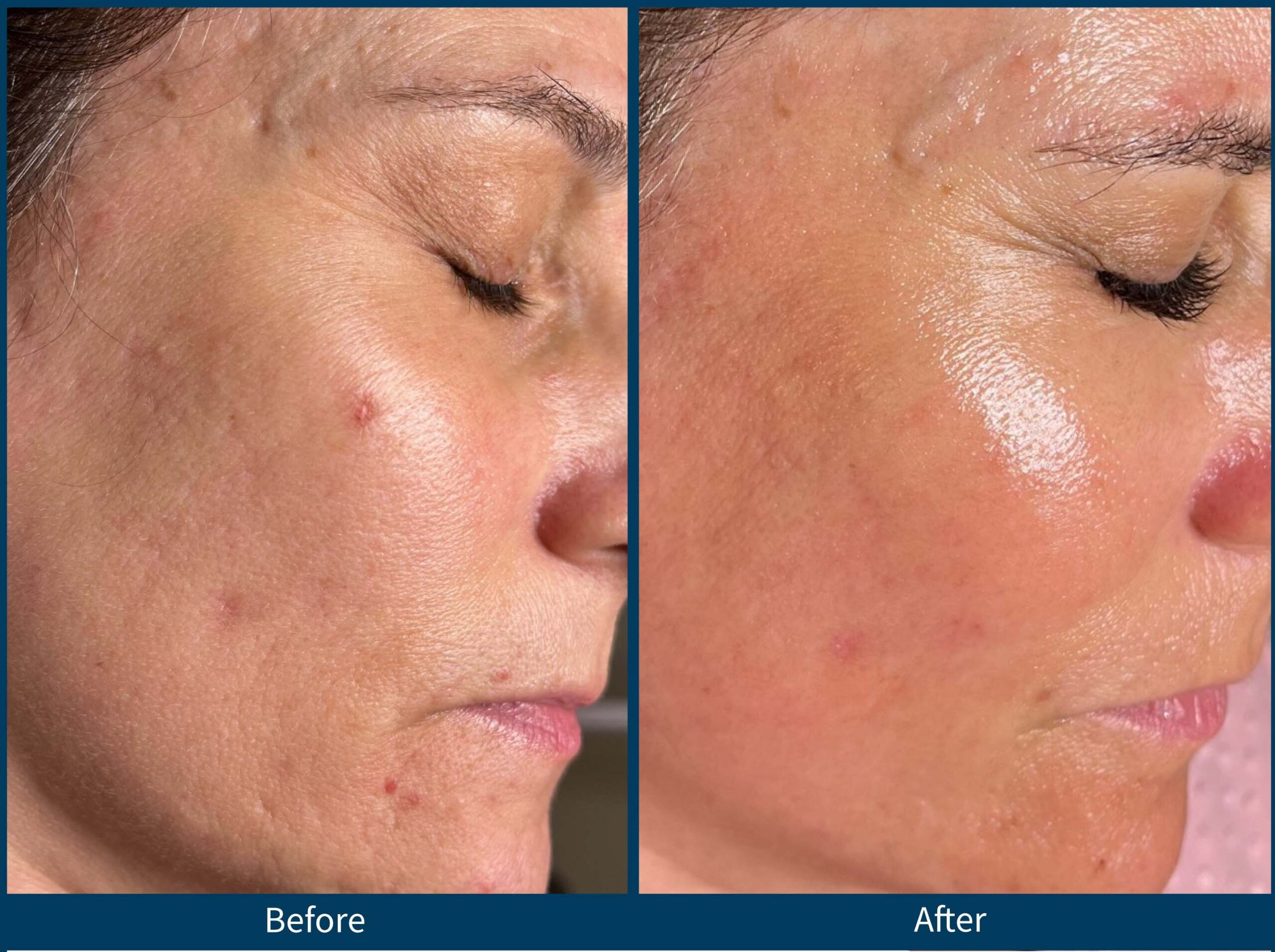 Microneedling SKIN PEN Beyer Eye Associates Eye Care Monmouth County NJ