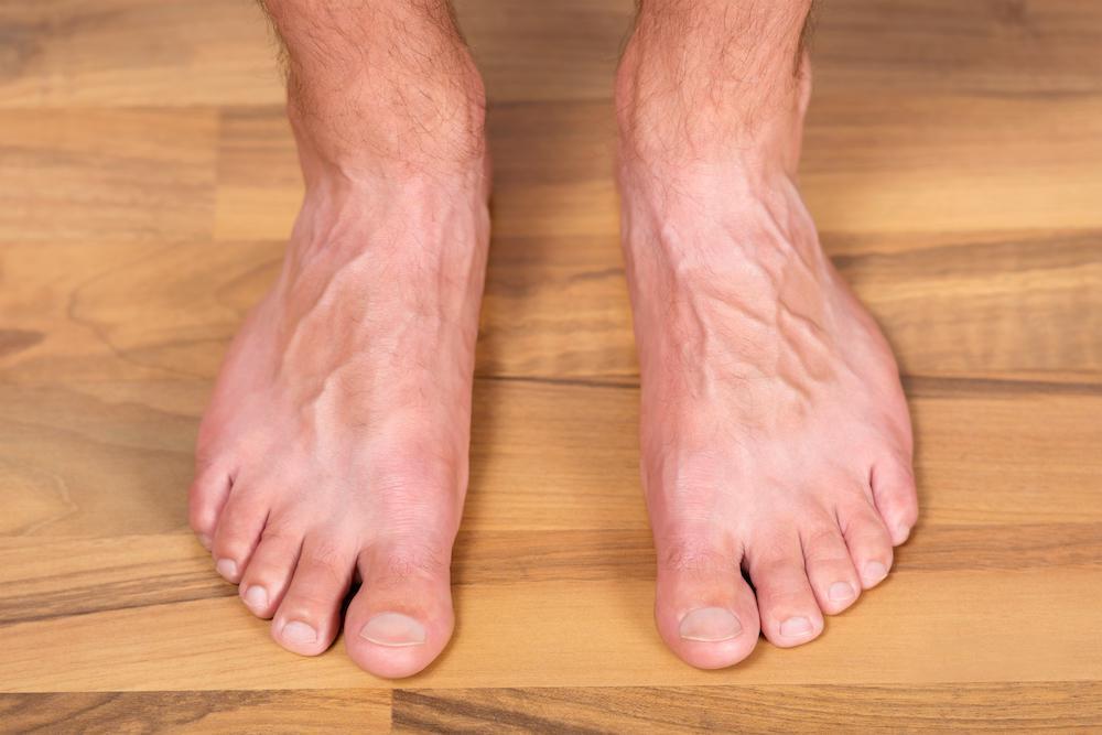 What is AdultAcquired Flatfoot and is it Serious? Beyond Podiatry