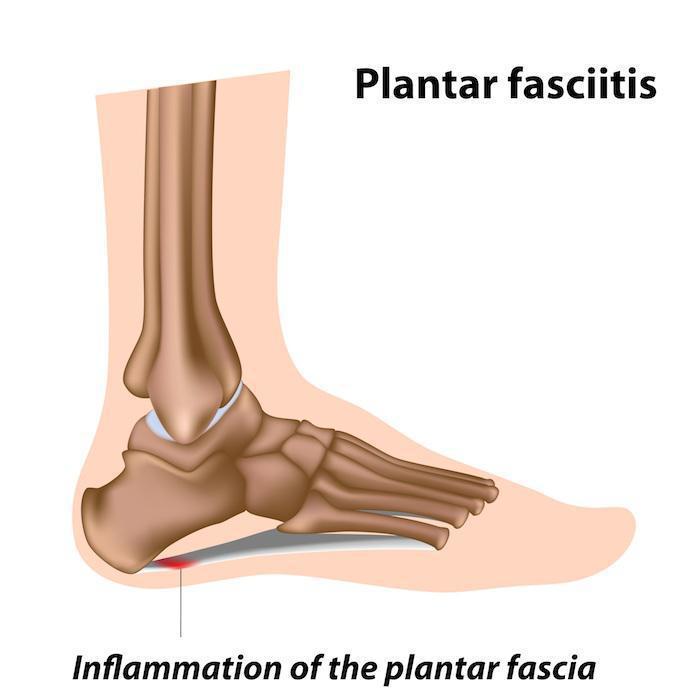 EPAT Treatment for Plantar Fasciitis Beyond Podiatry