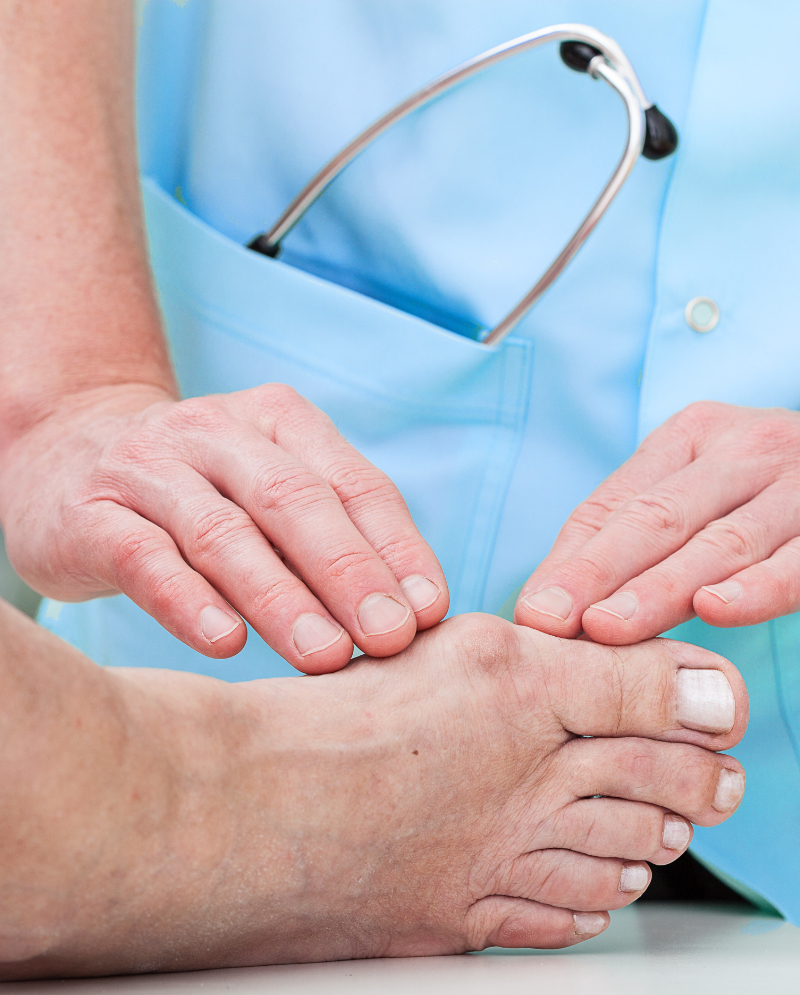 Bunion Surgery Michigan, Illinois Beyond Podiatry
