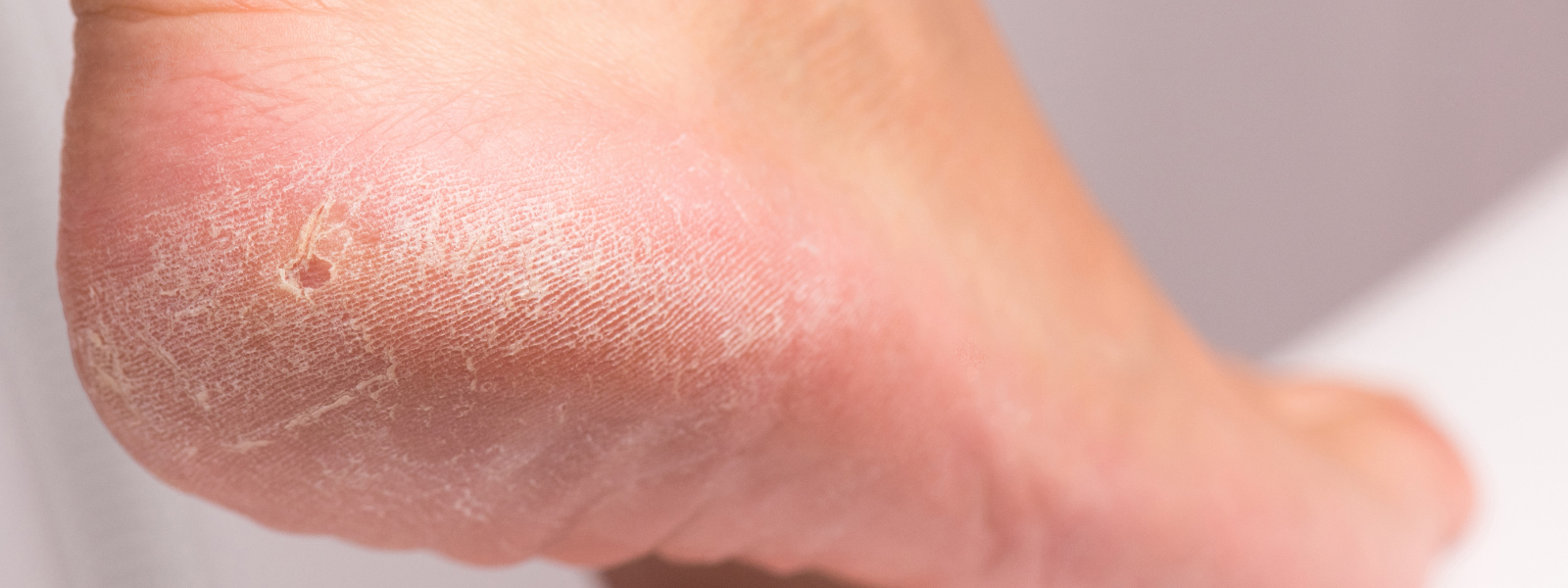 Treating Corns & Calluses Foot Health Beyond Podiatry