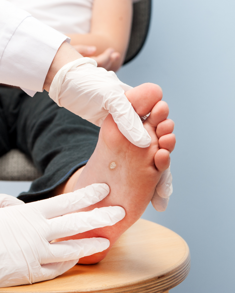 Treatments for Ulcers Foot Health Beyond Podiatry