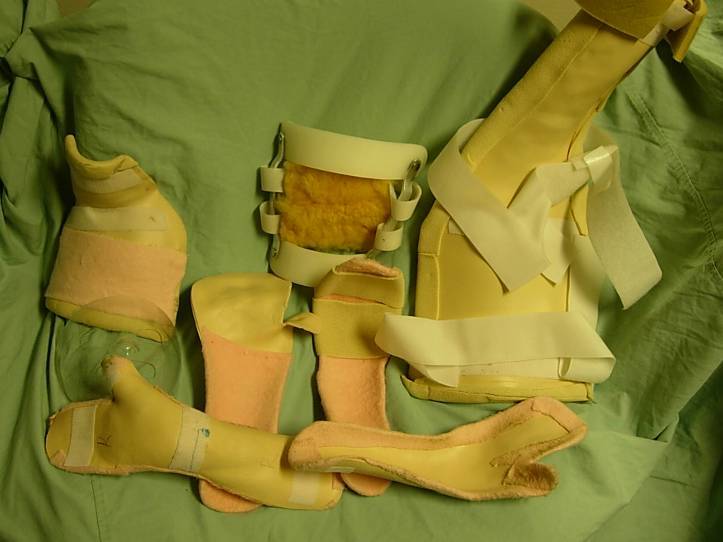 Wearing splints for burn injuries Beyond Burns