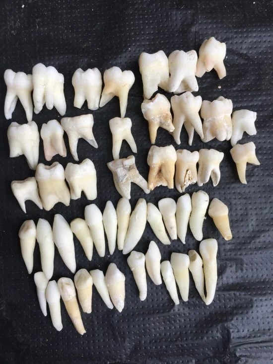 A SET OF 50 REAL HUMAN DECIDUOUS TEETH bforbones