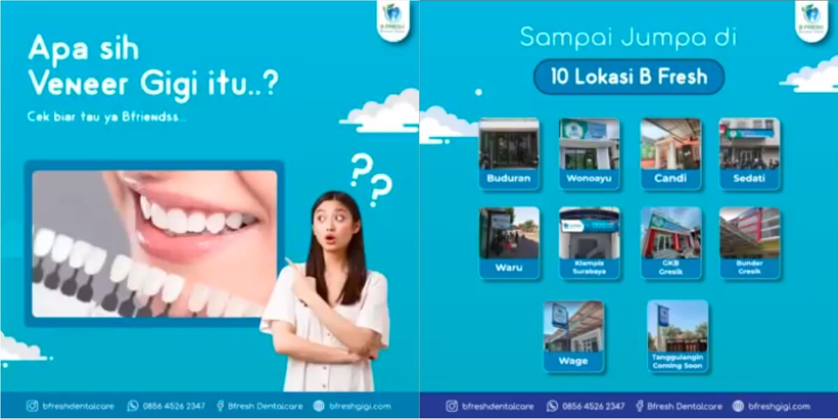 Apa itu Veneer Gigi Bfresh Dental Care