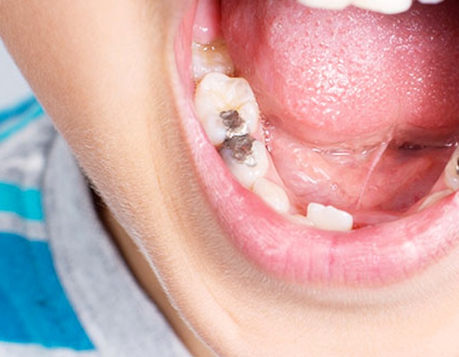 Study of tooth decay and fluorosis in Newcastle and Manchester