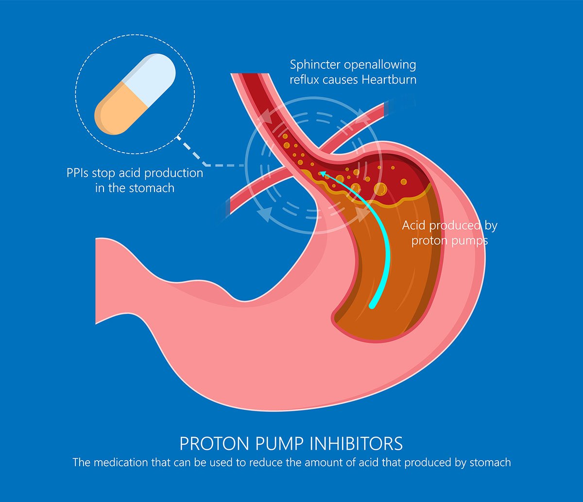 4 GERD Treatment Options Birmingham Gastroenterology Associates