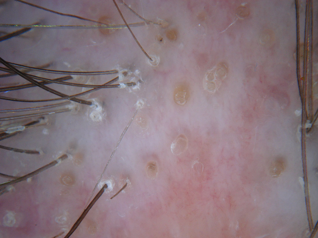 Folliculitis Scarring