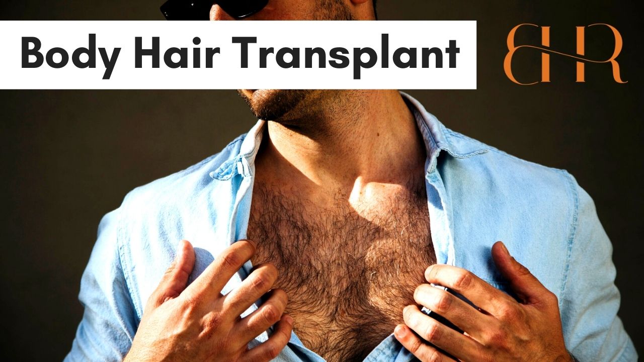 Body Hair Transplant Using Chest Hair for FUE Surgery (Bisanga Hair