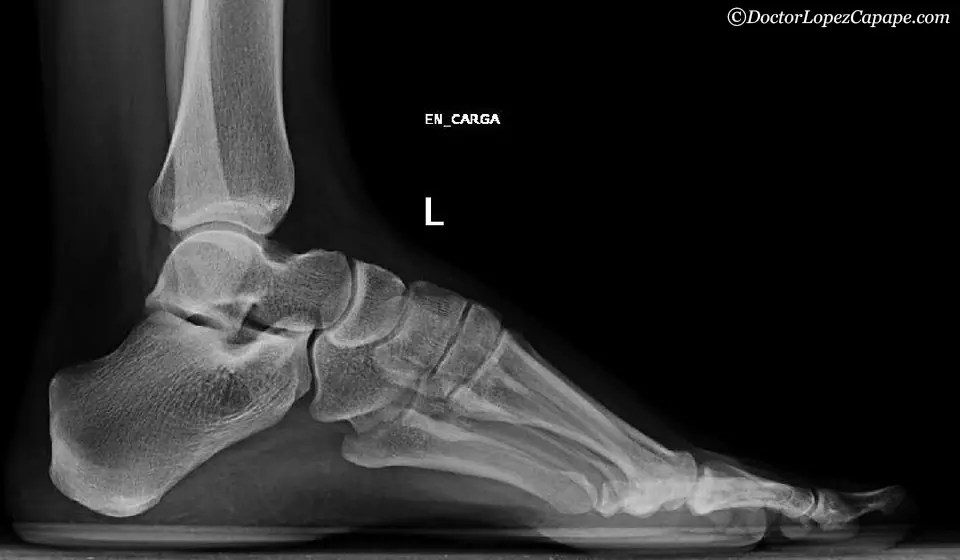 Pie Equino Varo Radiografia at Shannon Long blog