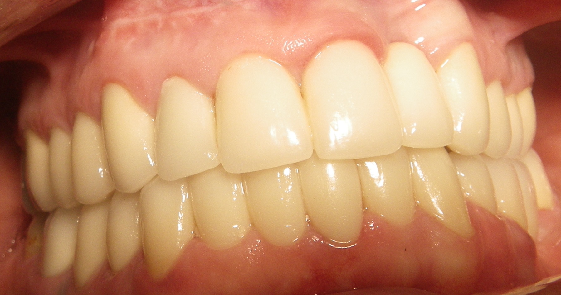 intrinsic staining Big Red Tooth Dr Candice Schwartz
