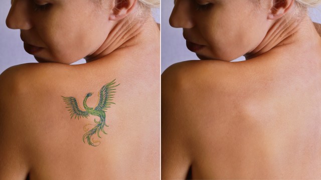 What Happens To Tattoos When You Remove Them? - Big Think 360_x_640_jpg