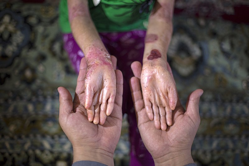 Battling "butterfly disease" Experimental therapy successfully regenerates skin Big Think