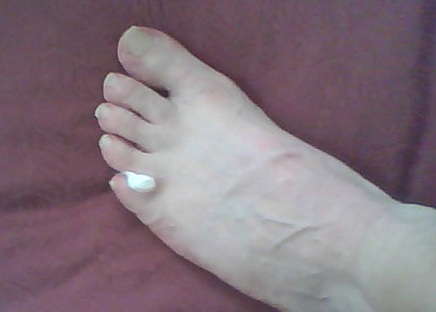 Hot Spot Cure - Bike Noob