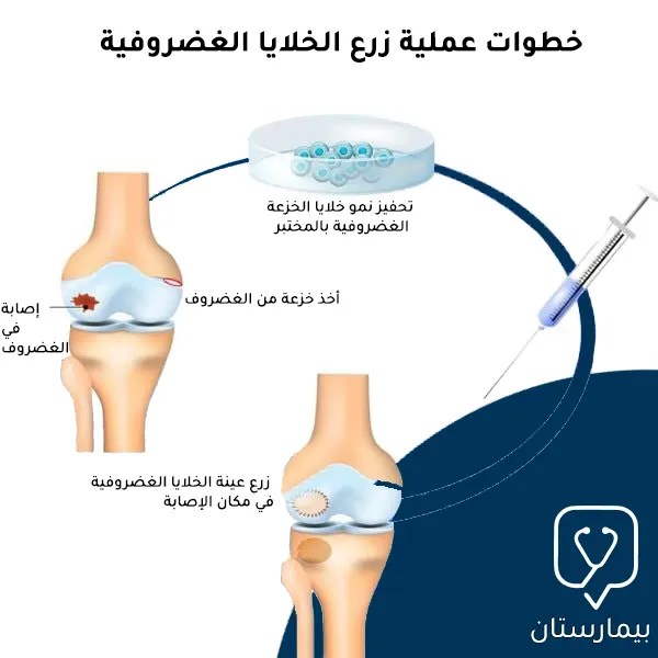Knee cartilage surgery using the latest methods in Turkey 2023 Bimaristan