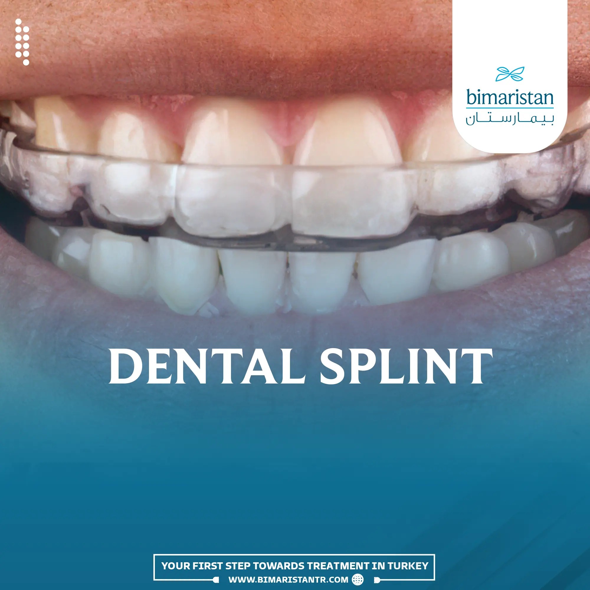 Types of dental splints and their uses in Turkey Bimaristan
