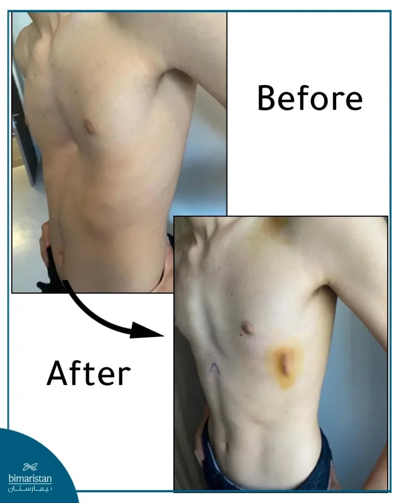 Pectus excavatum treatment in Turkey Bimaristan