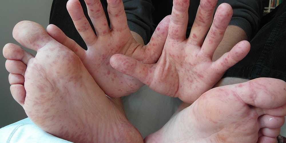 Hand, Foot And Mouth Disease Makes News In Asia — Bimc Hospital Bali