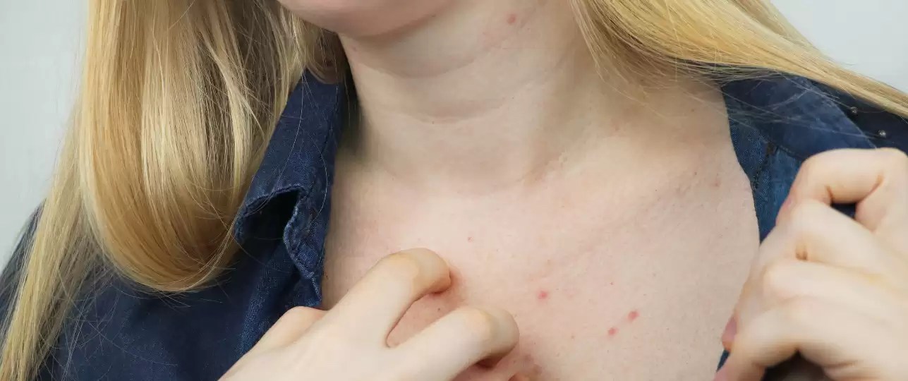 Schurft rukt op, zo herken je de symptomen Startpagina Blog