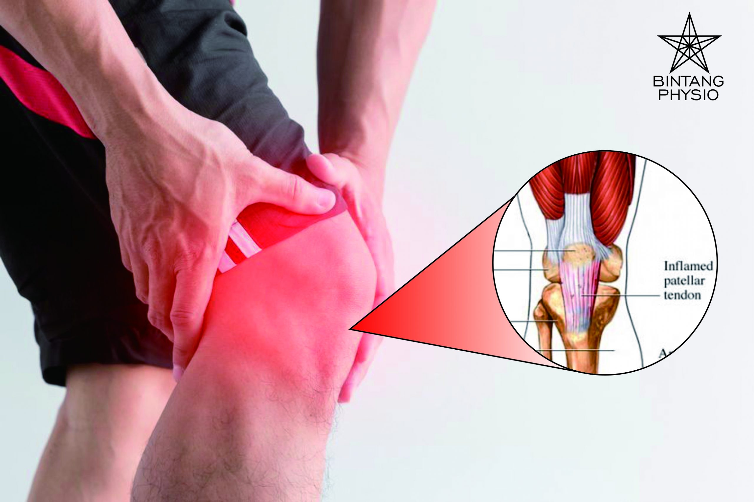 Patellar Tendinitis (Jumper’s Knee) Bintang Physio