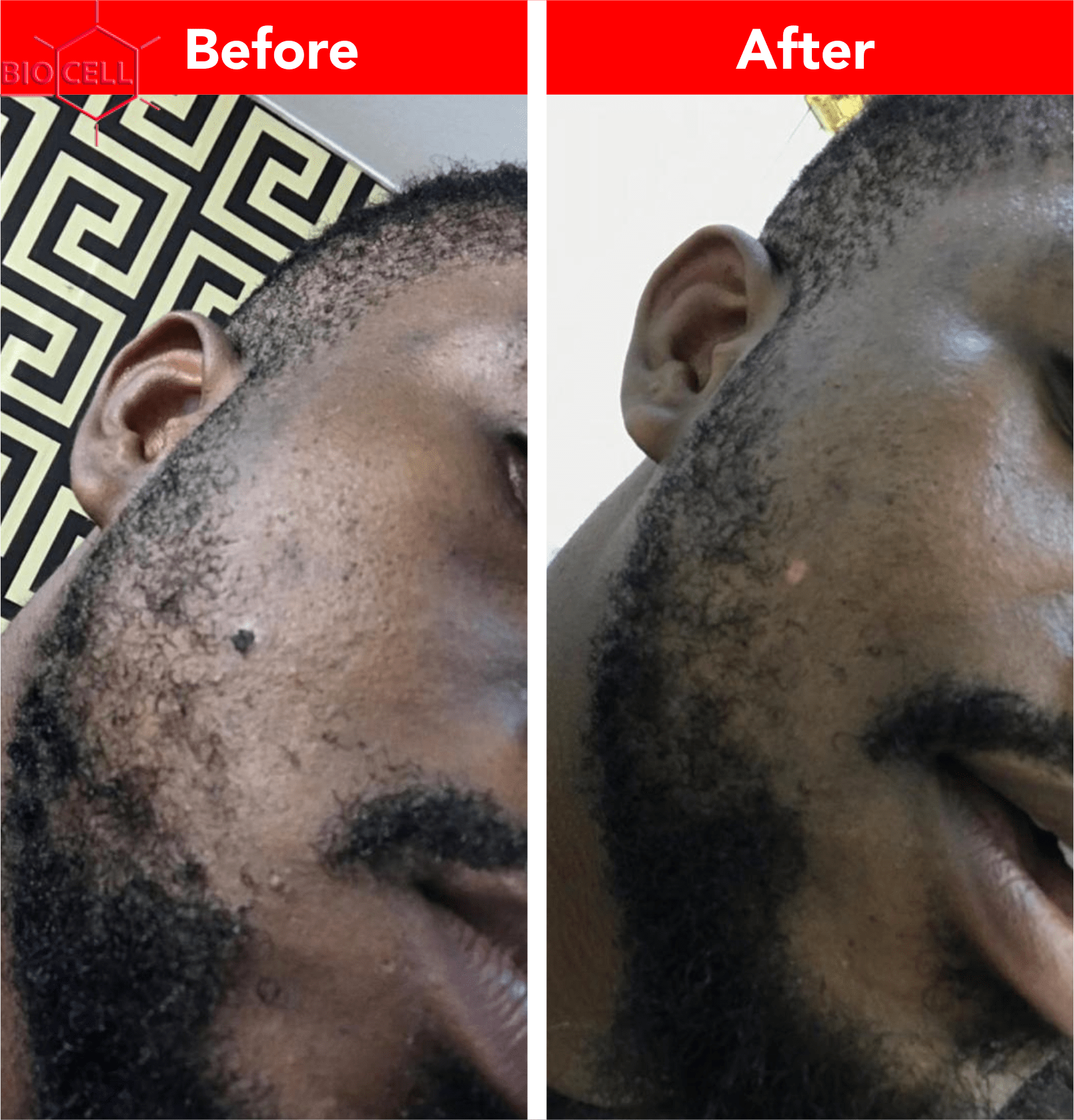 Skin Tag Removal Electrocoagulation BioCell Clinic Lagos