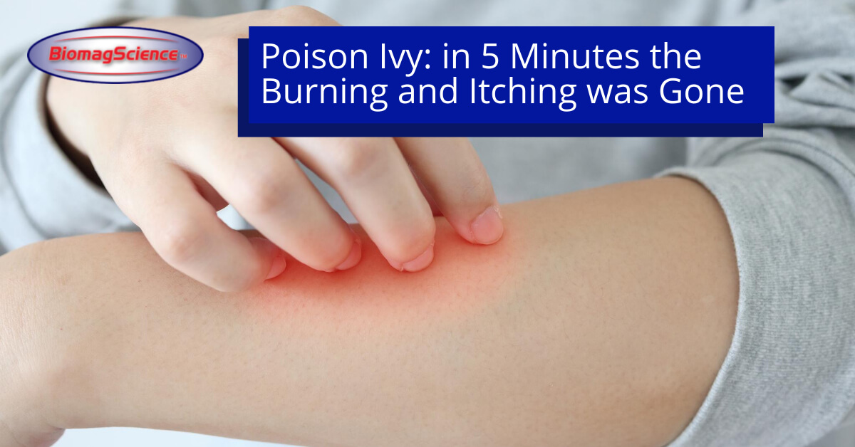 Poison Ivy In 5 Minutes The Burning And Itching Was Gone BiomagScience