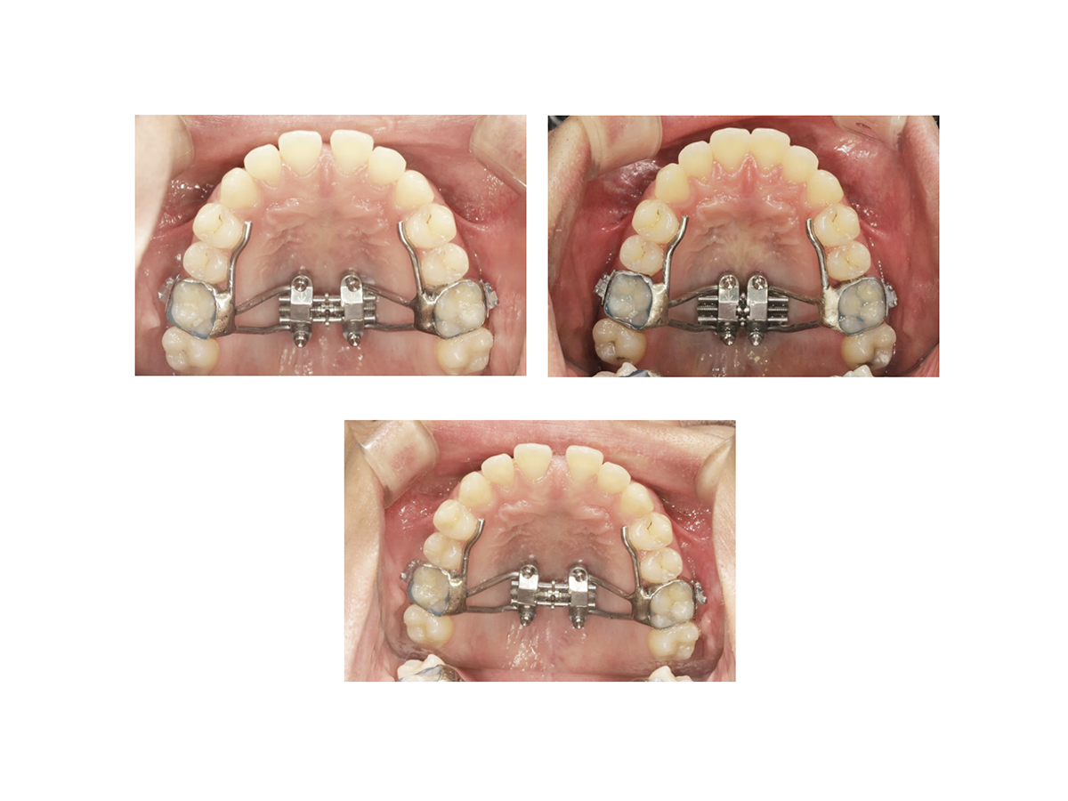 (주)바이오머테리얼즈코리아 MSE