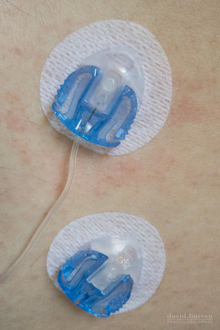 Pump cannulae and infusion sets what are the differences?