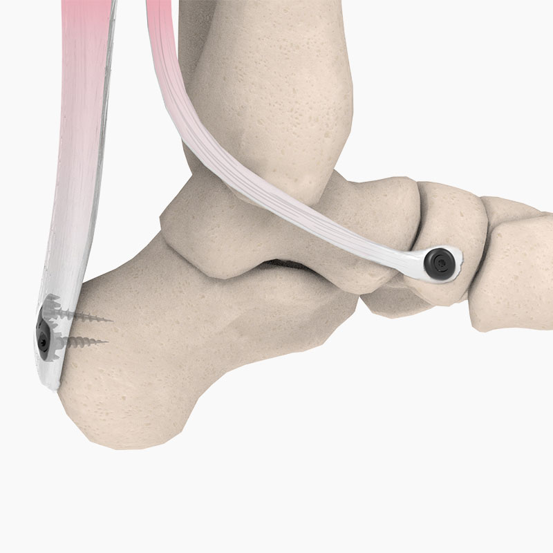 Tendon Anchor System