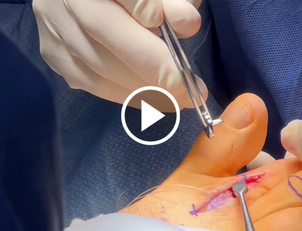 Youngswick Osteotomy Procedure with the AccuCut Osteotomy Guide System
