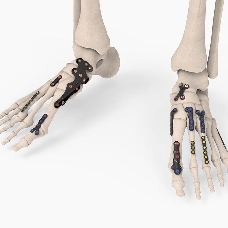 Forefoot/Midfoot/Hindfoot Plating System