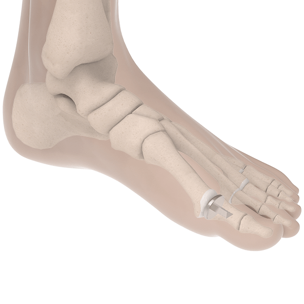BioPro Hemi Toe Implant for Hallux Rigidus