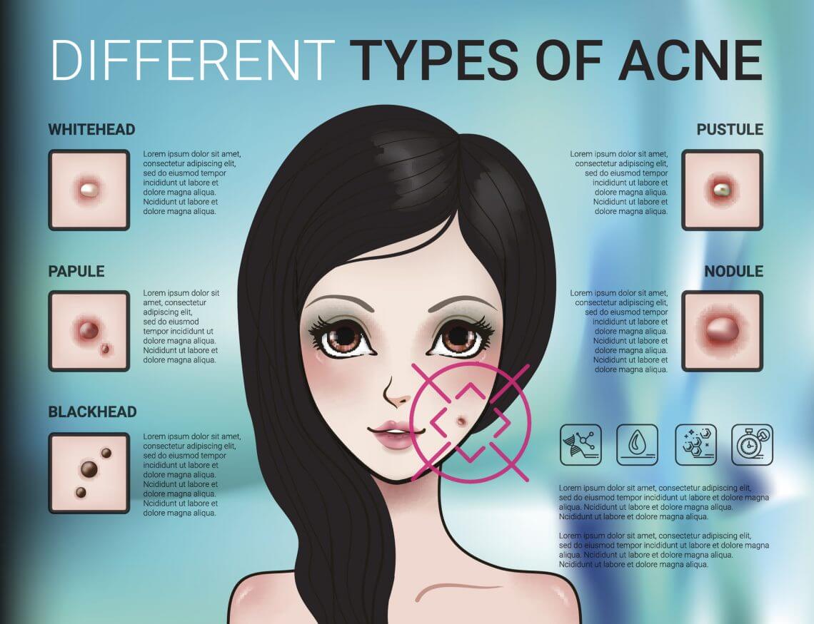 Infographics of different type of skin acne BiOptimizers