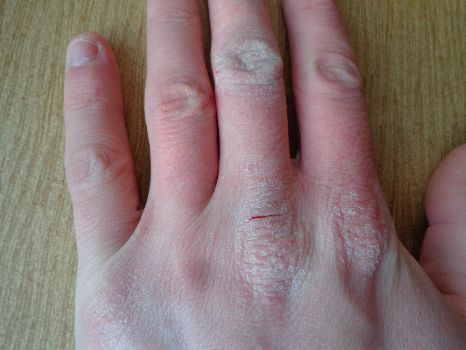 Atopic dermatitis hand BioSol