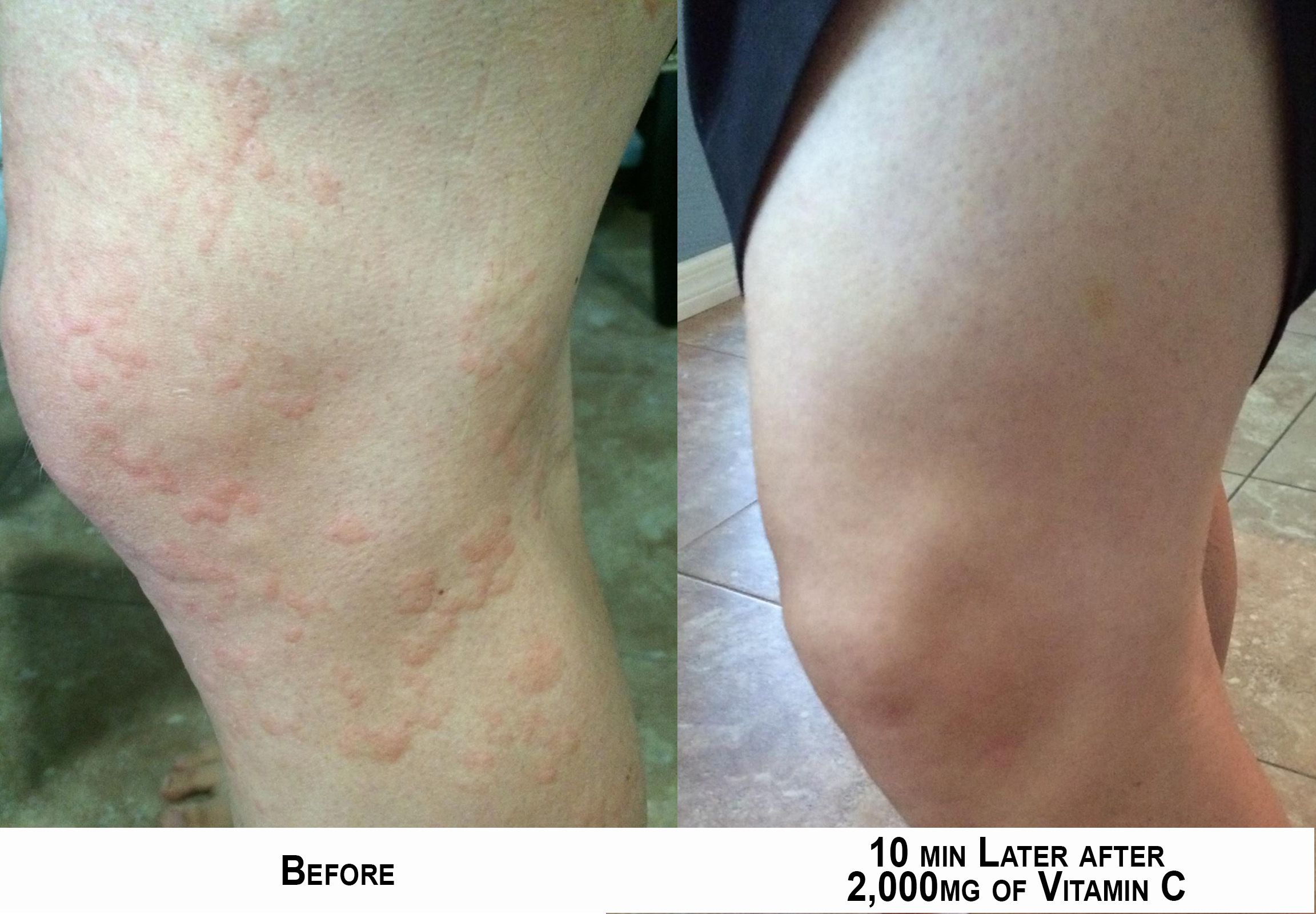 How To Avoid Dry Feet Caused By Vitamin Deficiency Bio Time inc