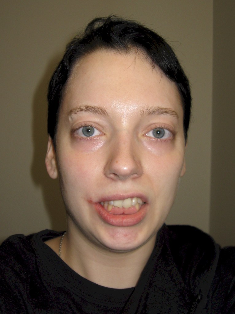 DENTAL ANESTHESIA SIDE EFFECTS