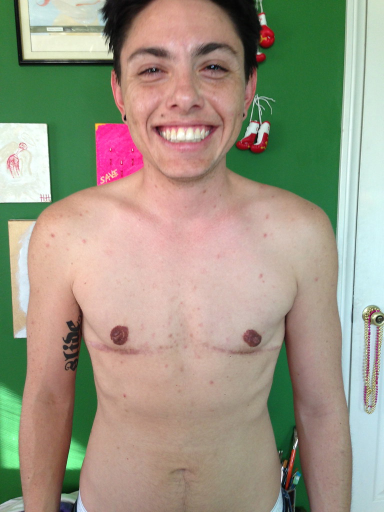 MALE TO FEMALE SURGERY