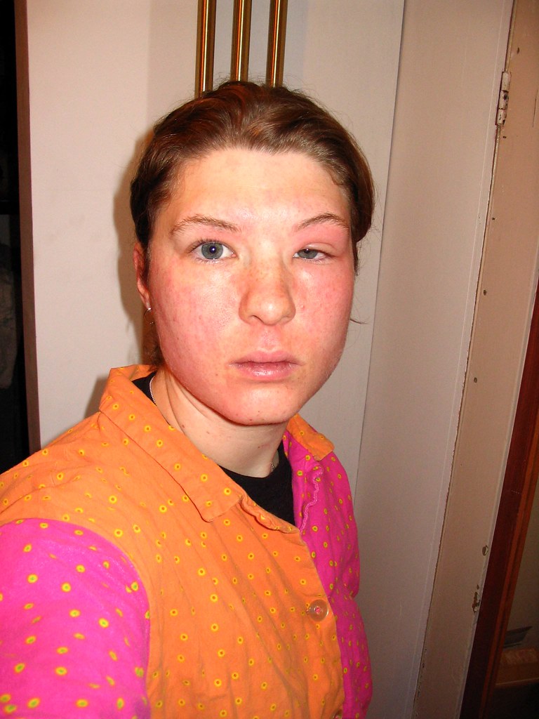 SKIN ALLERGY REMEDY ALLERGY REMEDY Skin Allergy Remedy Nut