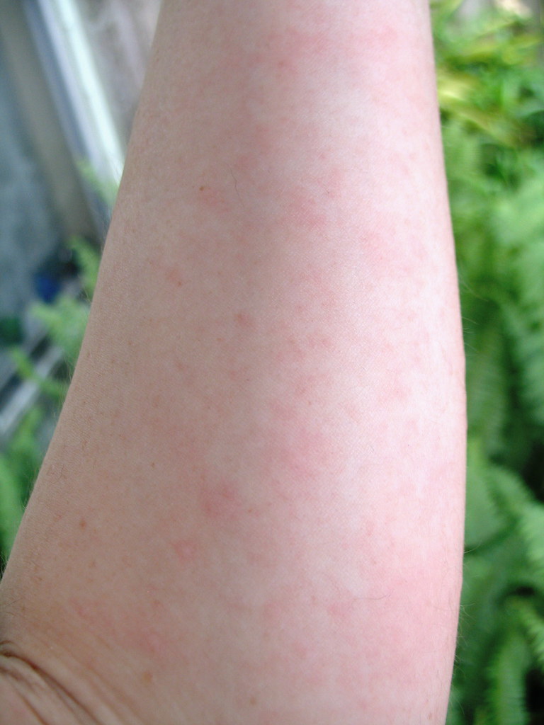 SKIN ALLERGY REMEDY ALLERGY REMEDY Skin Allergy Remedy Nut