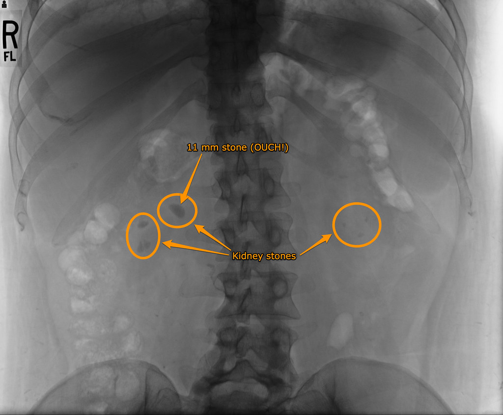 SYMPTOMS OF KIDNEY STONES IN WOMEN